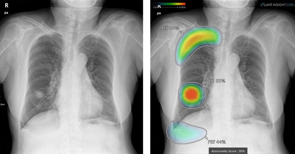 ‘루닛 인사이트 CXR’이 환자 흉부 엑스레이에서 관찰되는 이상소견의 위치 및 각 소견의 확률을 표기한 모습. [사진=루닛]