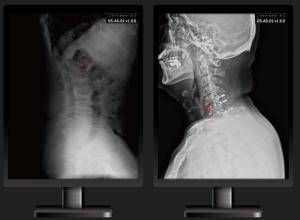 딥노이드, 척추부위 의료영상 AI솔루션 식약처 인증 획득