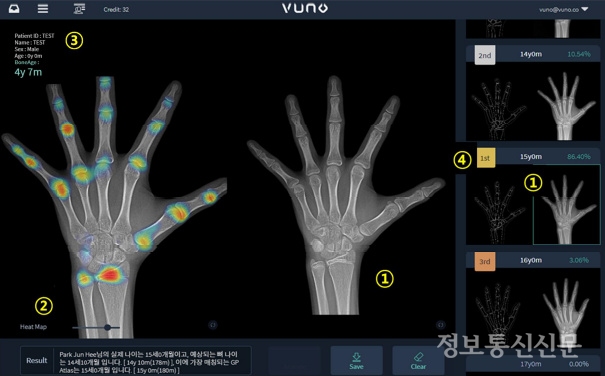 ㈜뷰노의 의료영상 분석 소프트웨어. 환자의 좌측 손 X-ray 영상에 대한 골연령을 분석해 의료인이 환자의 골연령을 판단하는 것을 지원한다. [자료=식약처]
