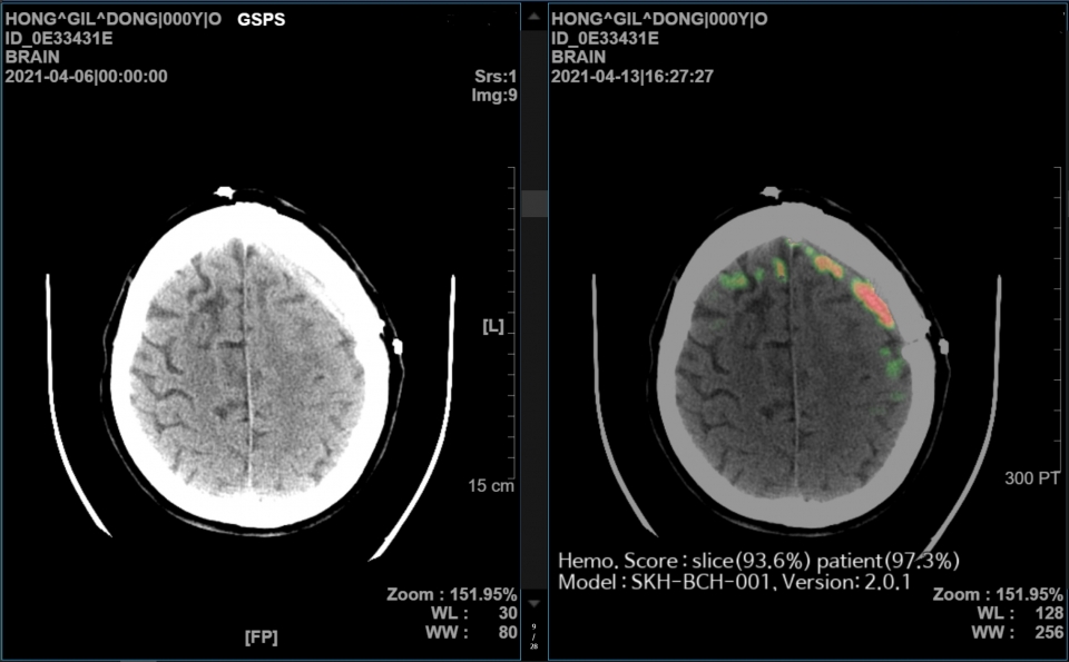 SK(주) C&C AI 뇌출혈 영상 의료 솔루션(메디컬 인사이트 플러스 뇌출혈) 데모(Demo) 화면.